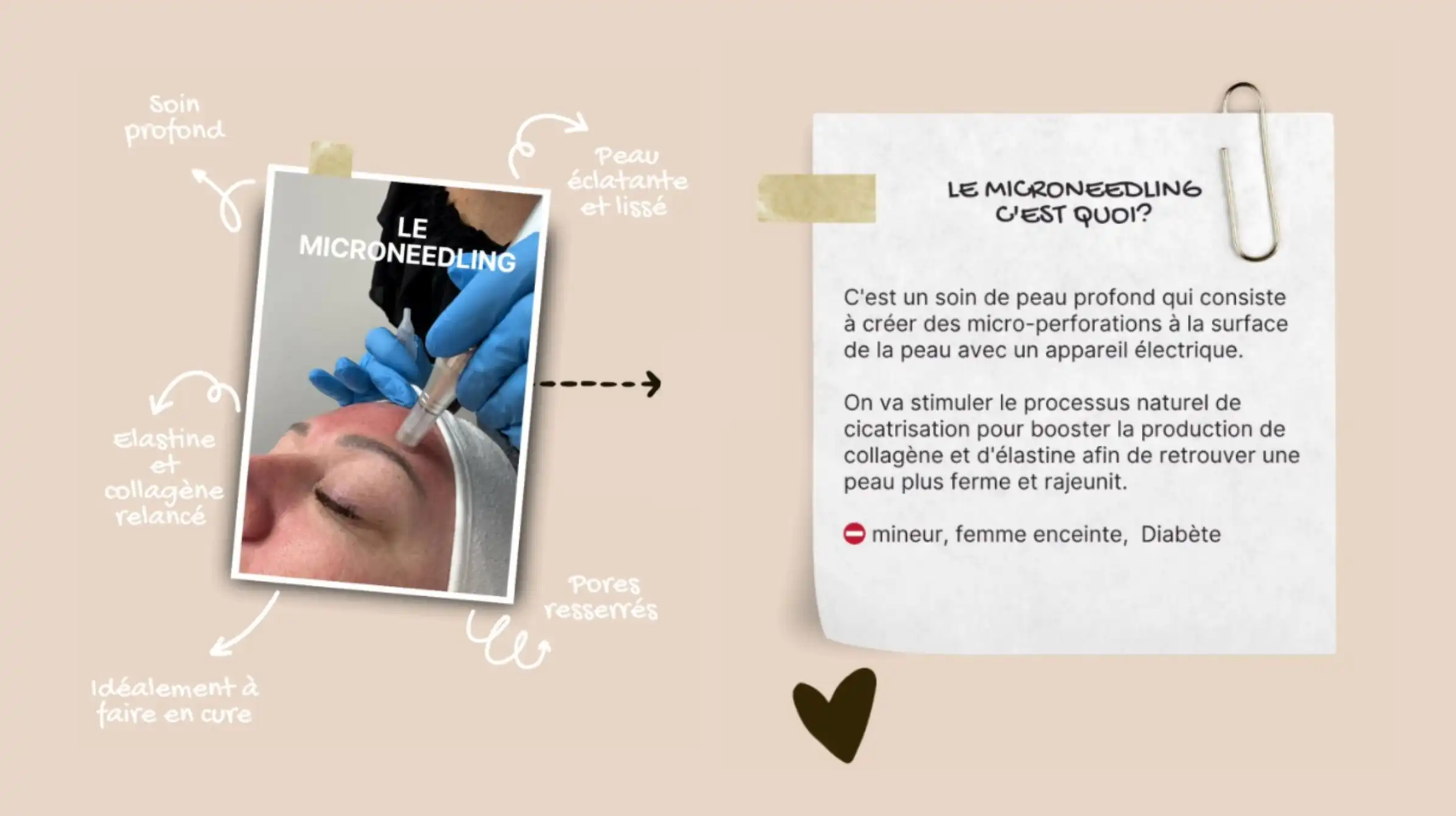 microneedling